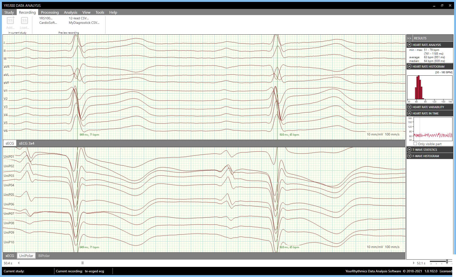 Analysis SW Sinus Rhythm patient[17]